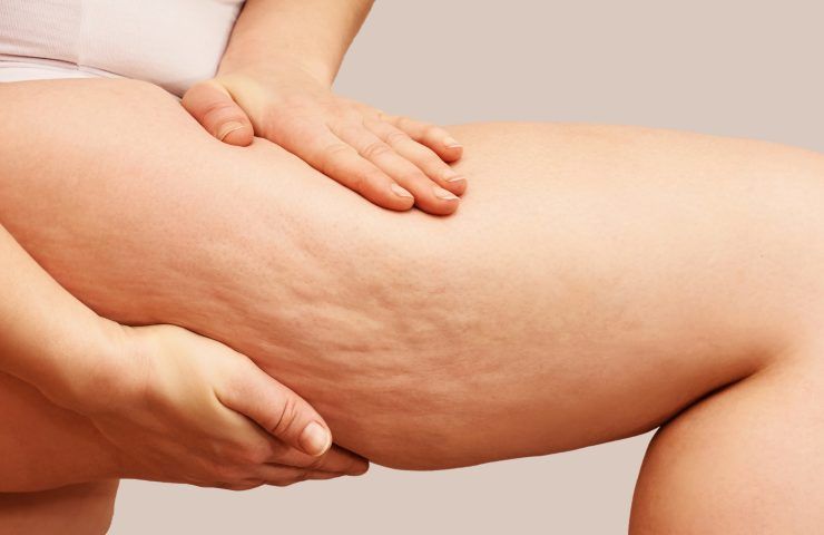 rimedi cellulite