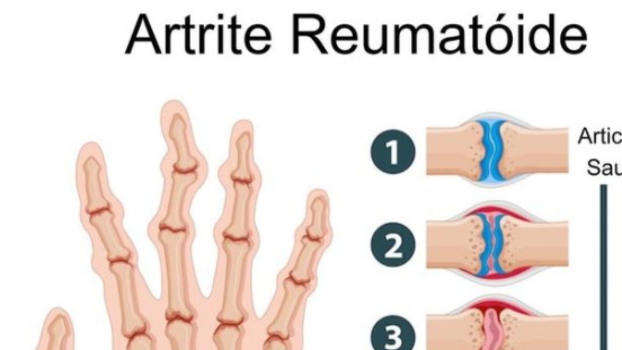 artrite reumatoide cura yoga