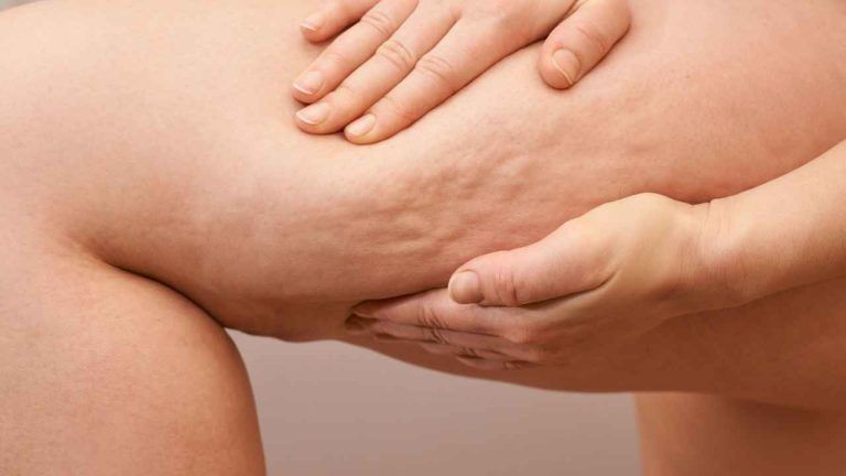 Sconfiggere la cellulite: quali sono le abitudini quotidiane per eliminarla Sconfiggere la cellulite: quali sono le abitudini quotidiane per eliminarla