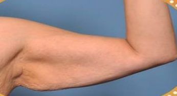 Braccia a tendina, l’esercizio definitivo per risolvere il fastidio: che risultati