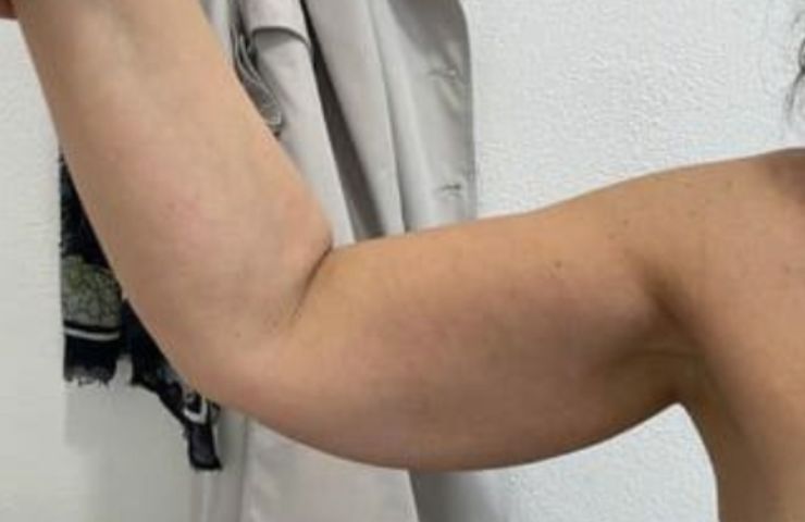La muscolatura delle braccia