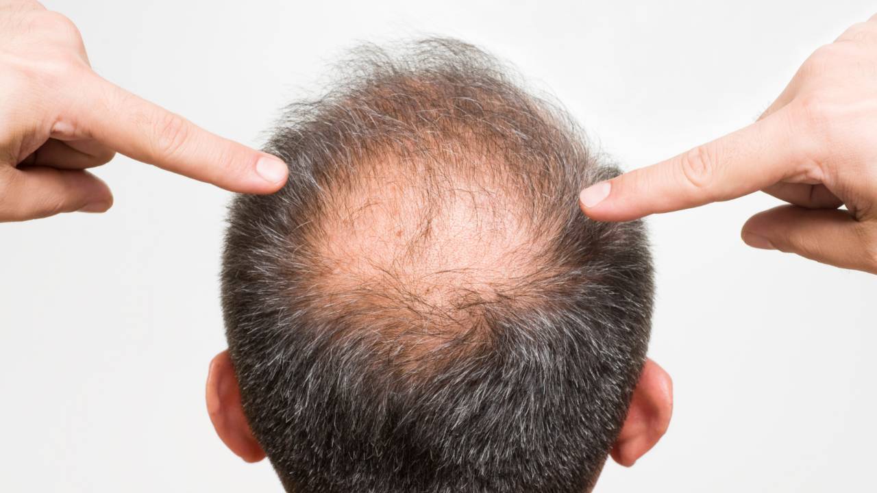 alopecia cosa mangiare alimenti consigliati